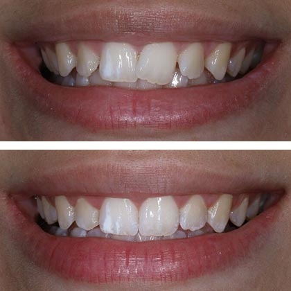 Dr. Todd Goldstein's patient Mya before and after Invisalign