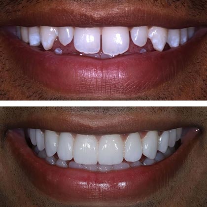 Dr. Todd Goldstein's patient Sakib before veneers