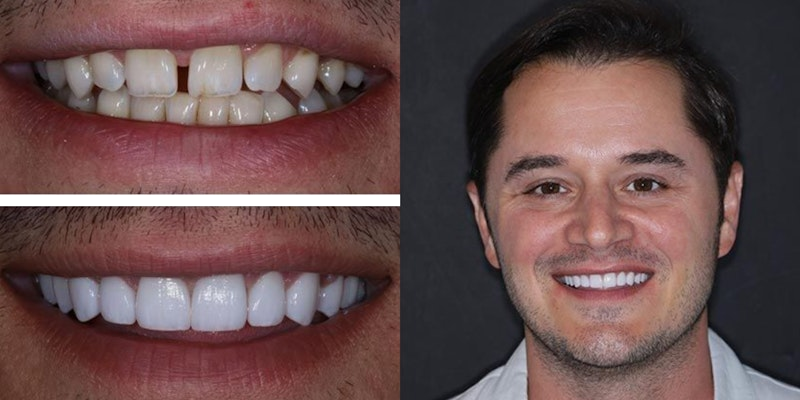 Veneers Real Result