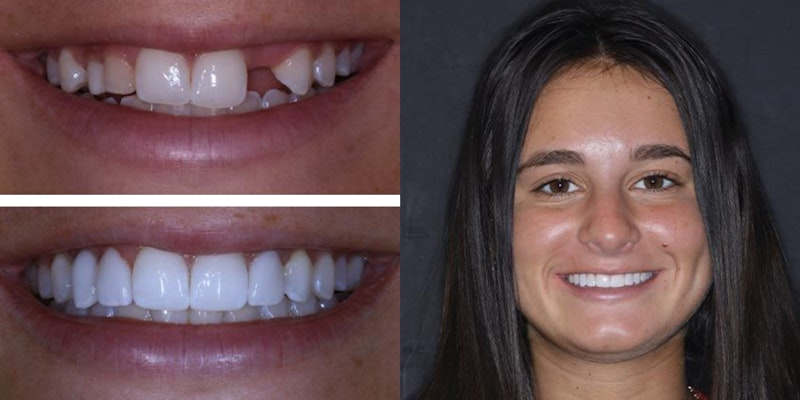 Implants Real Result