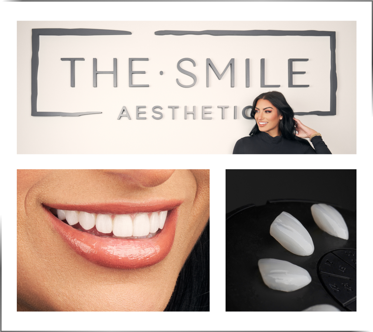 collage of porcelain veneer patient and veneers