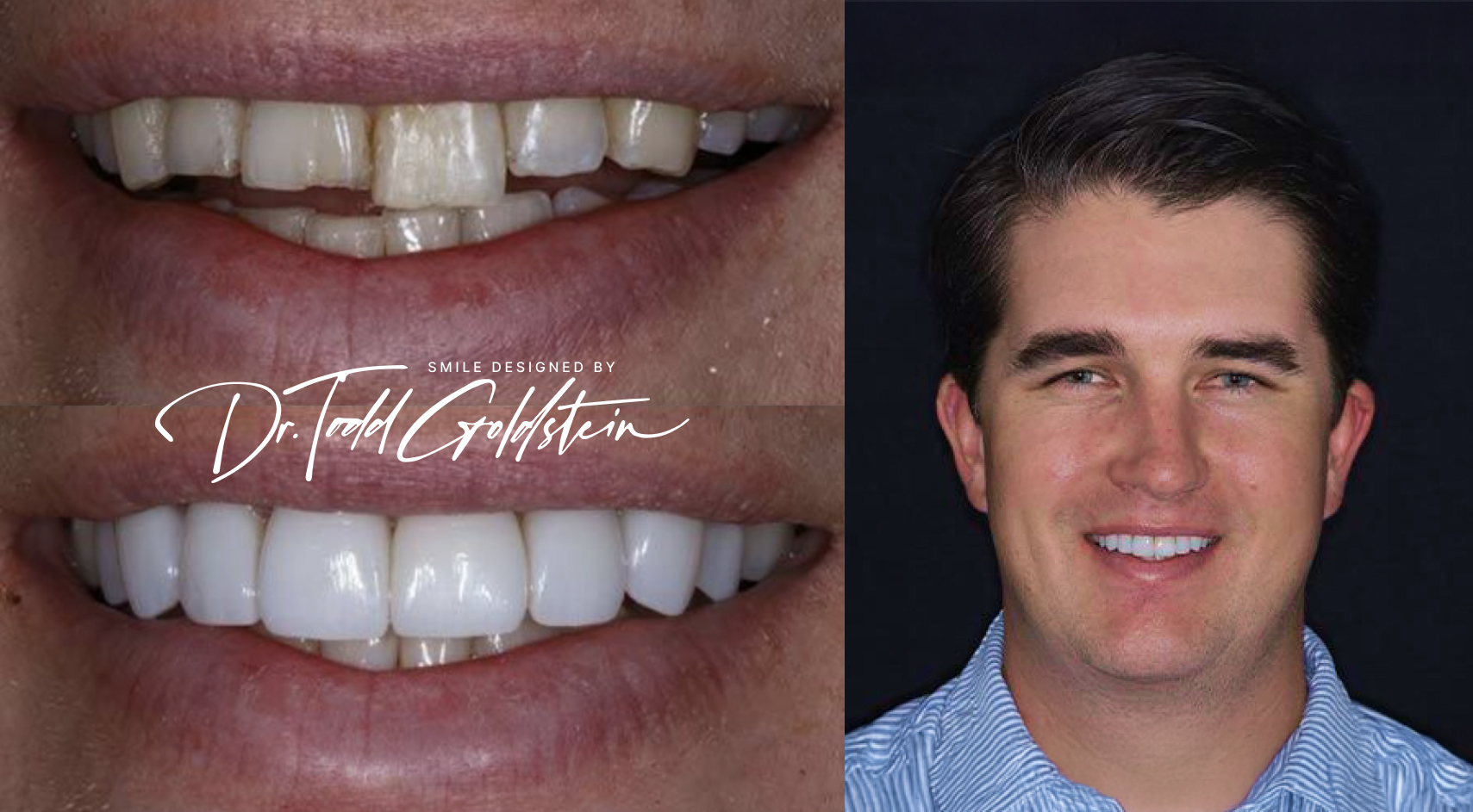Pete before and after veneers in Red Bank