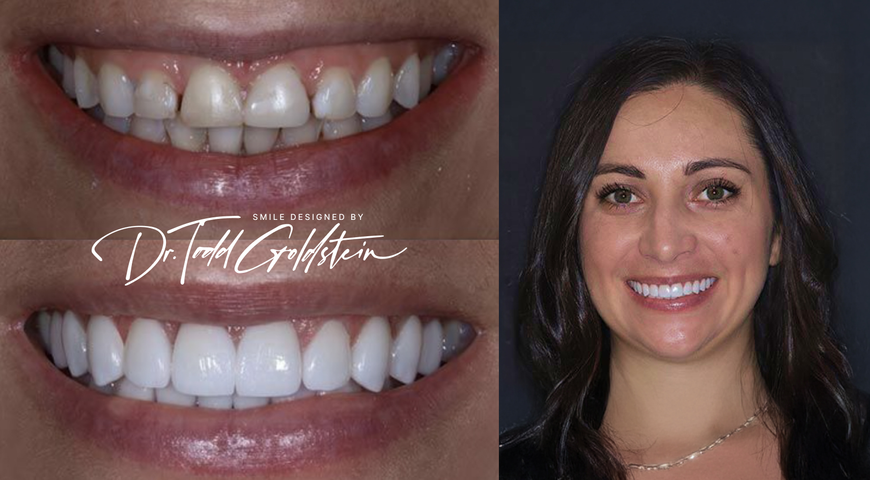 Lauren before and after porcelain veneers