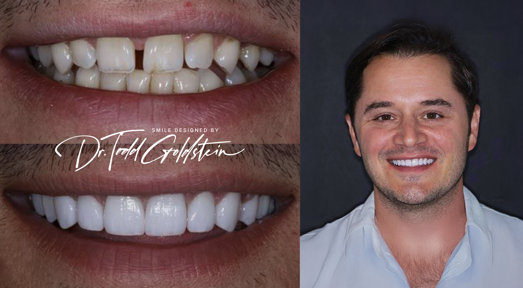 Christopher before and after veneers in Red Bank