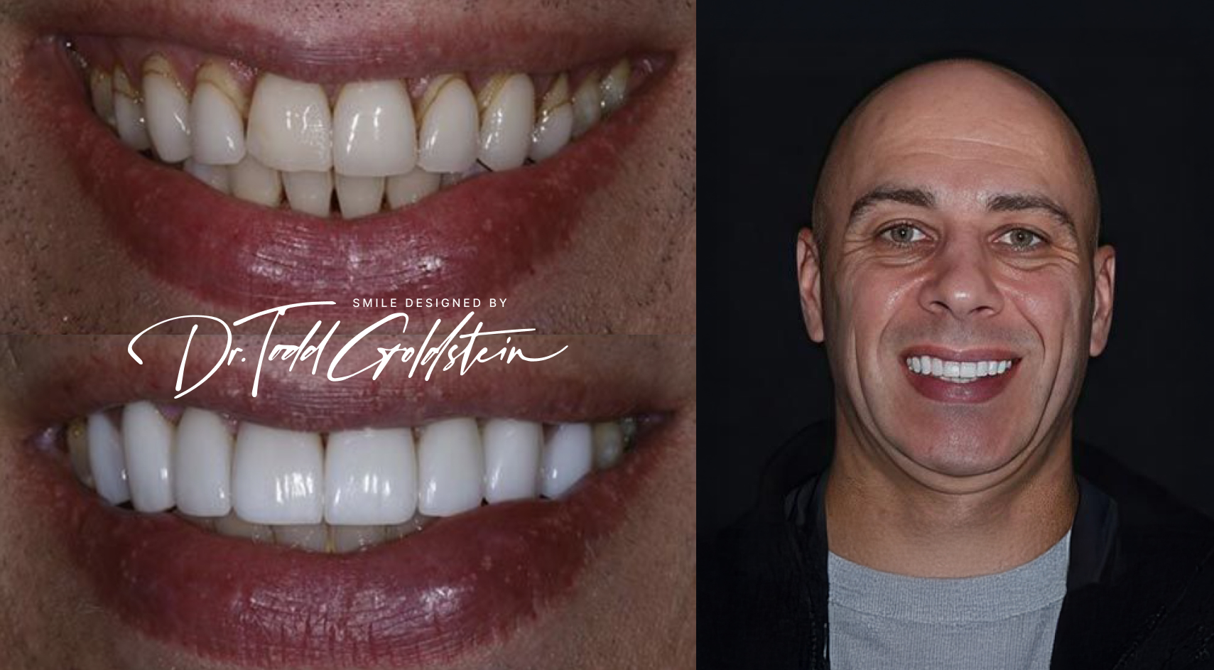 Michael before and after veneers in Red Bank, NJ