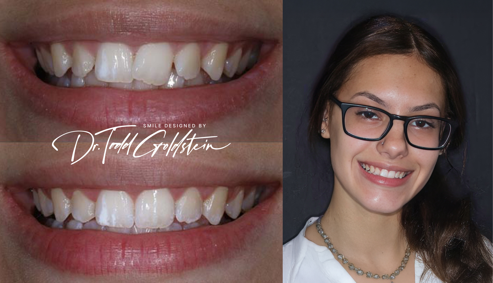 Marissa before and after Invisalign