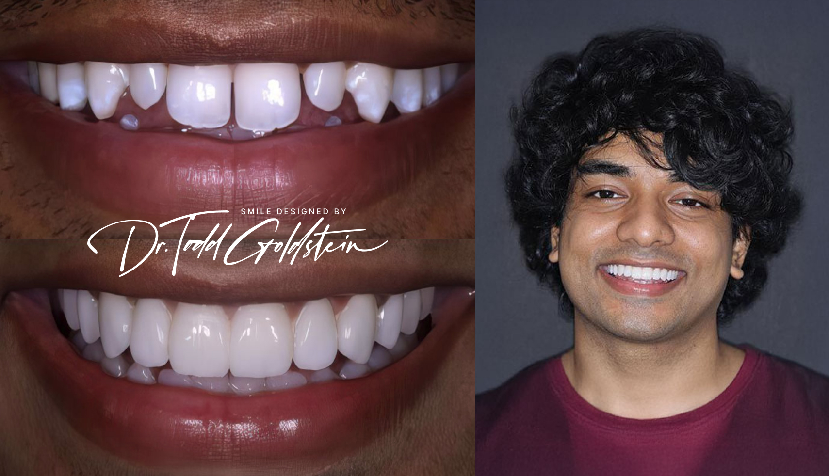 Sakib before and after veneers