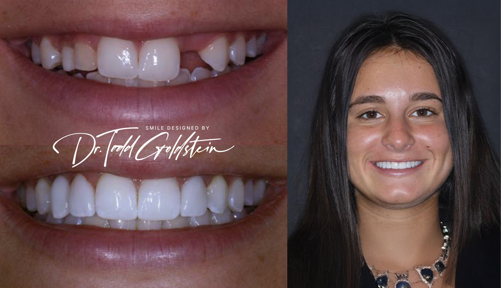 Nicole before and after a smile makeover