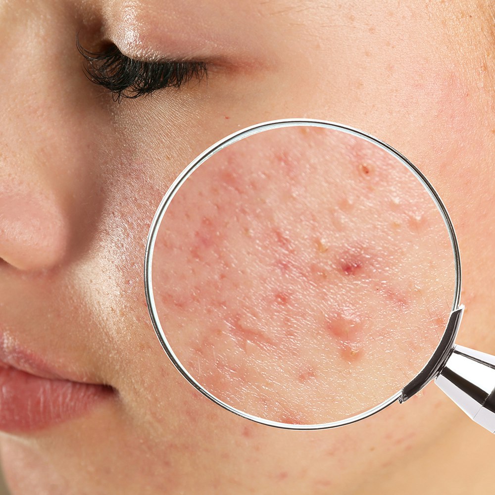 acne on a person's face