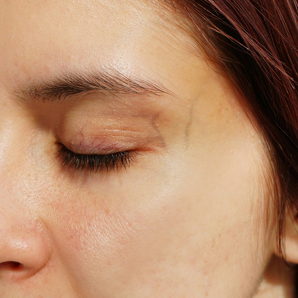 a person with visible veins next to their eyes