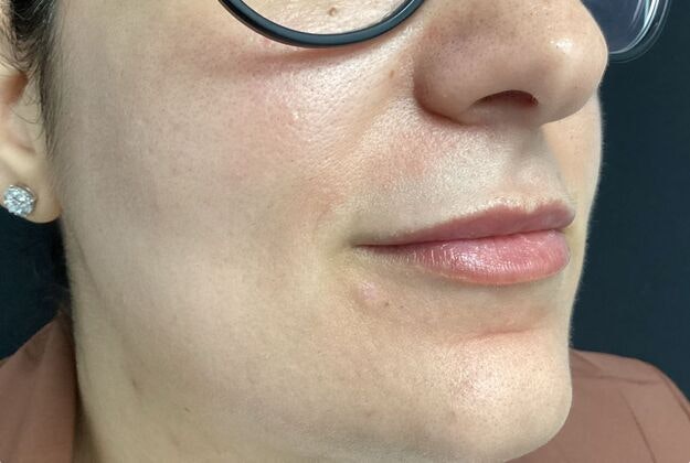 After laser resurfacing