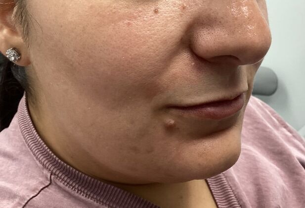 before laser skin resurfacing
