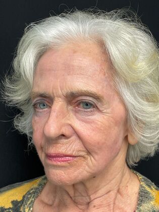 after laser skin resurfacing