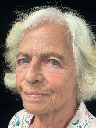 before laser resurfacing