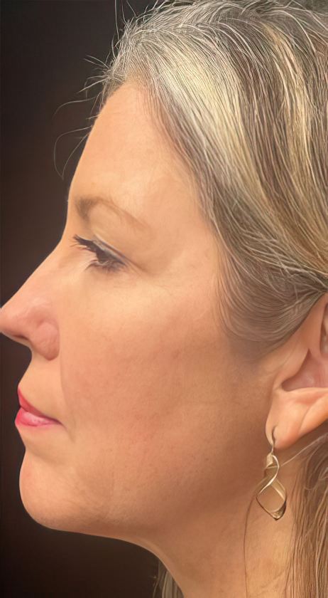 FaceTite patient after treatment