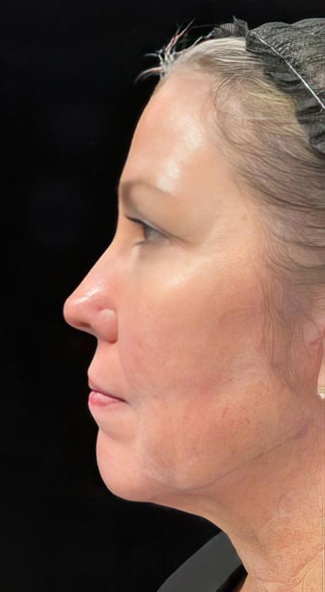 FaceTite patient before treatment