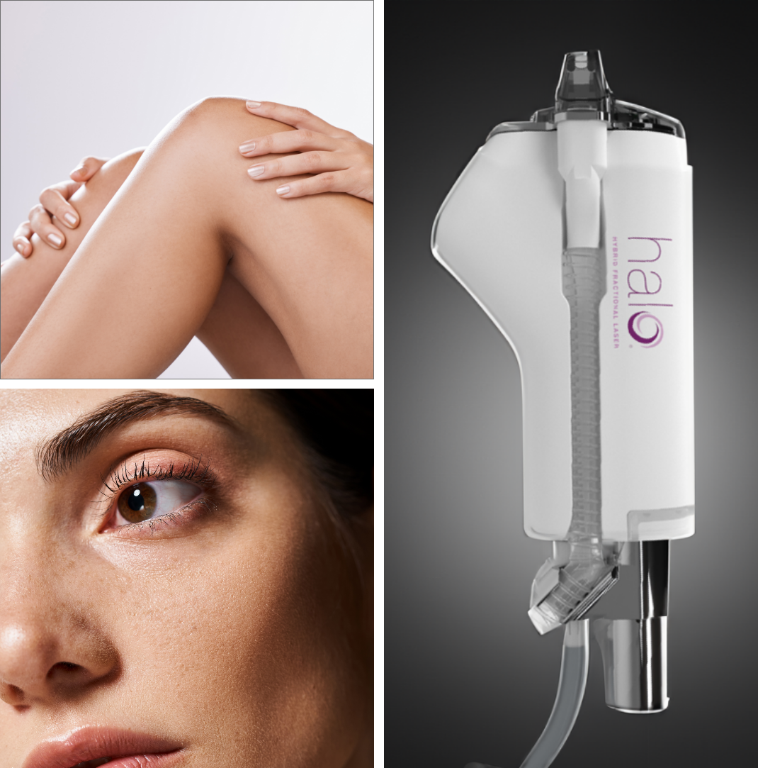 HALO skin resurfacing laser used at our Tampa, FL, office