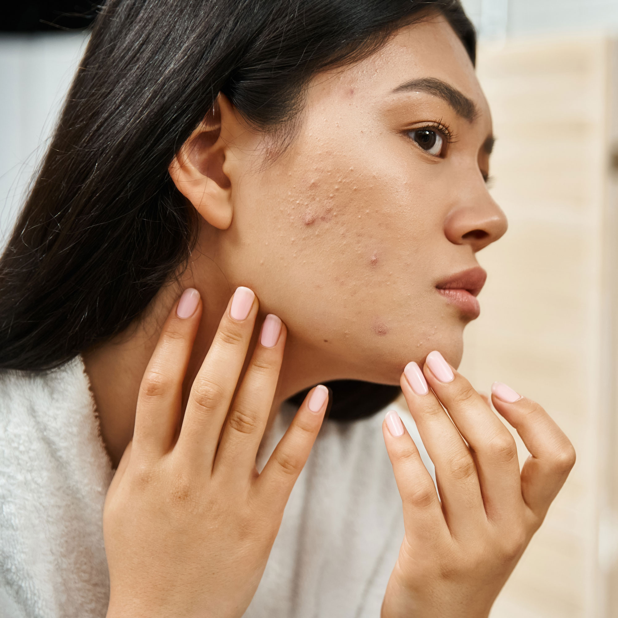 Woman looking at acne in mirror
