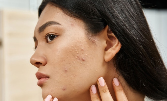 Woman looking at acne in mirror