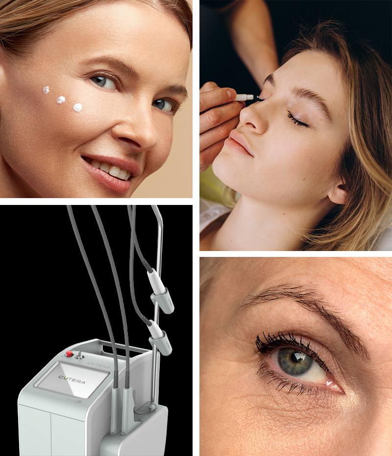 collage of woman with lotion, woman having an eye procedure, a Cutera device, and a woman