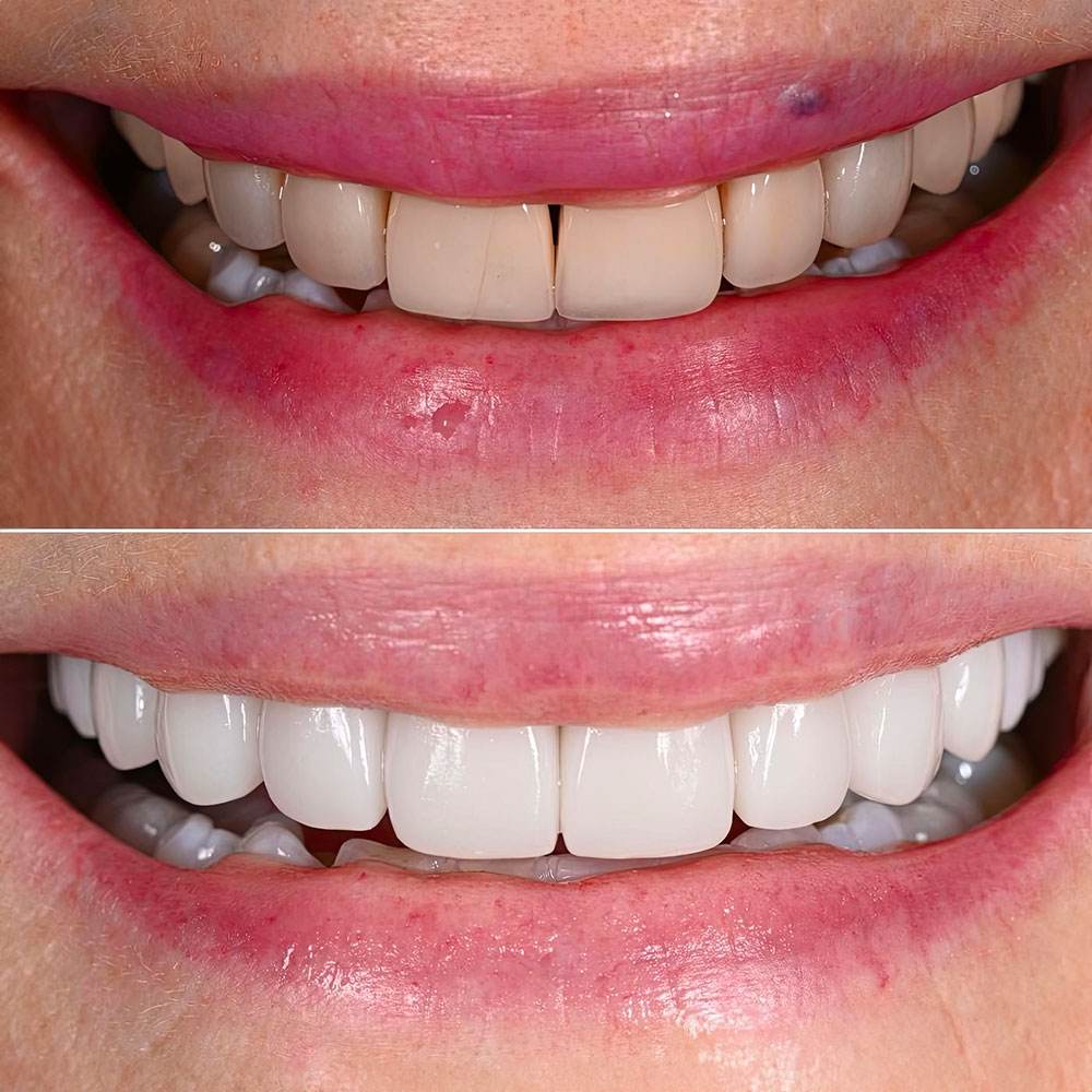 Patient before and after veneers