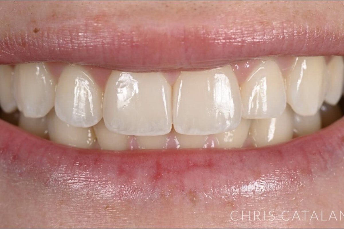 after whitening and veneers