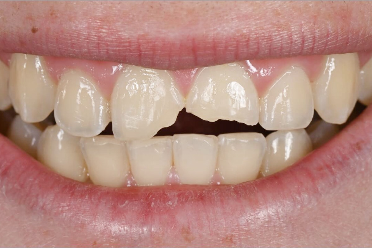 before whitening and veneers