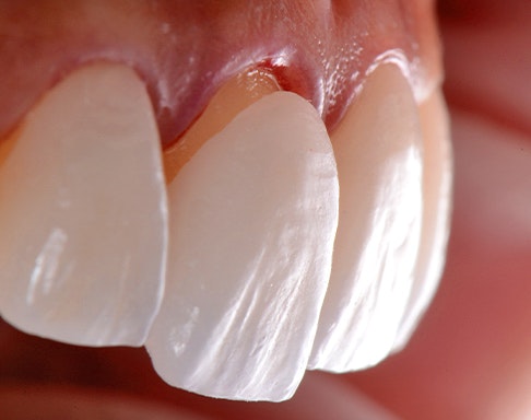 a dental veneer