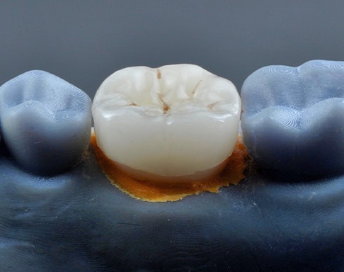 a milled dental crown