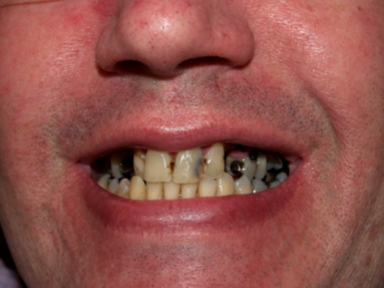 patient before dental implants