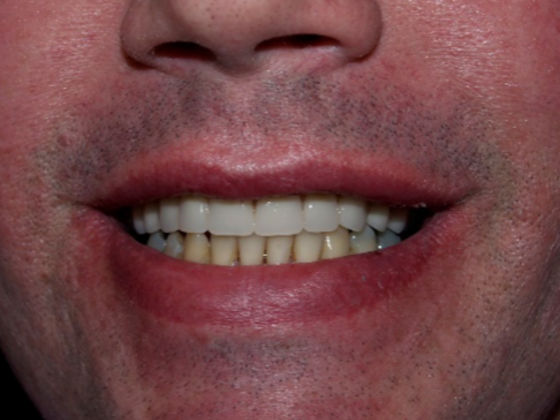 patient after dental implants