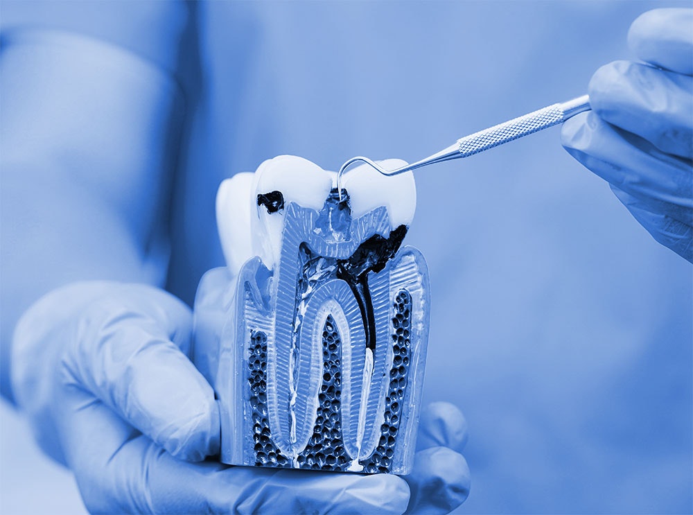 Model of an infected tooth
