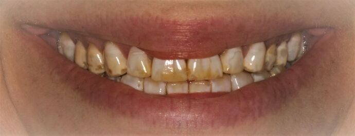 Real Patient Before Veneers
