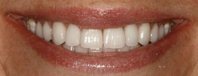 Real Patient After Veneers