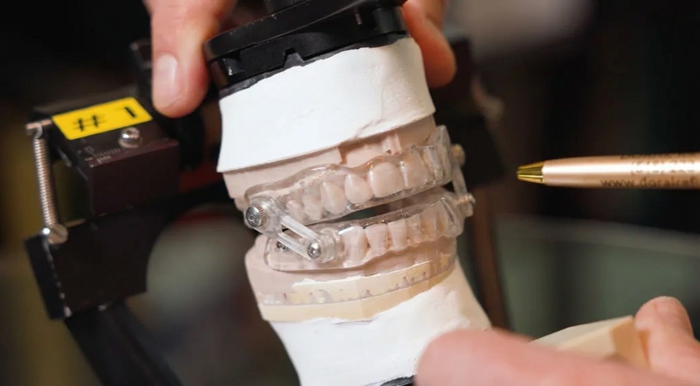 creating a sleep apnea oral appliance