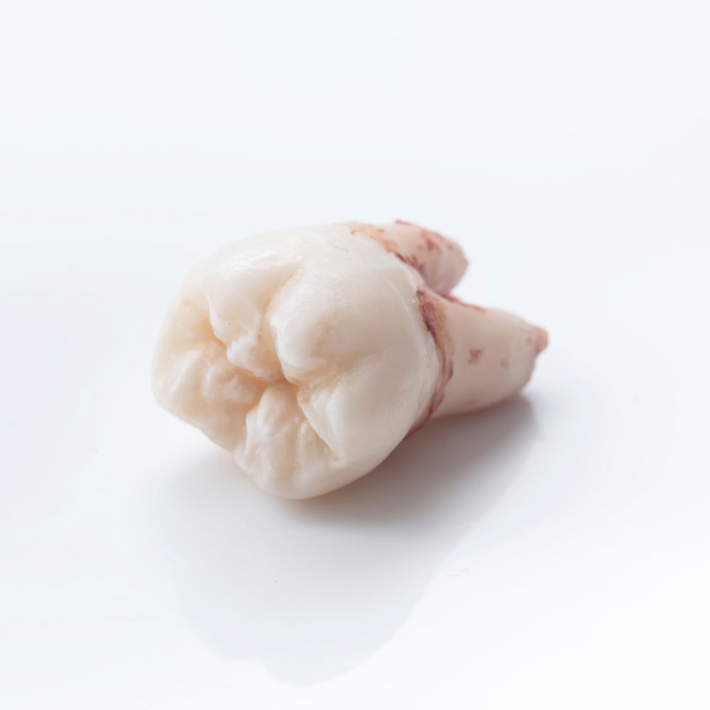 wisdom tooth