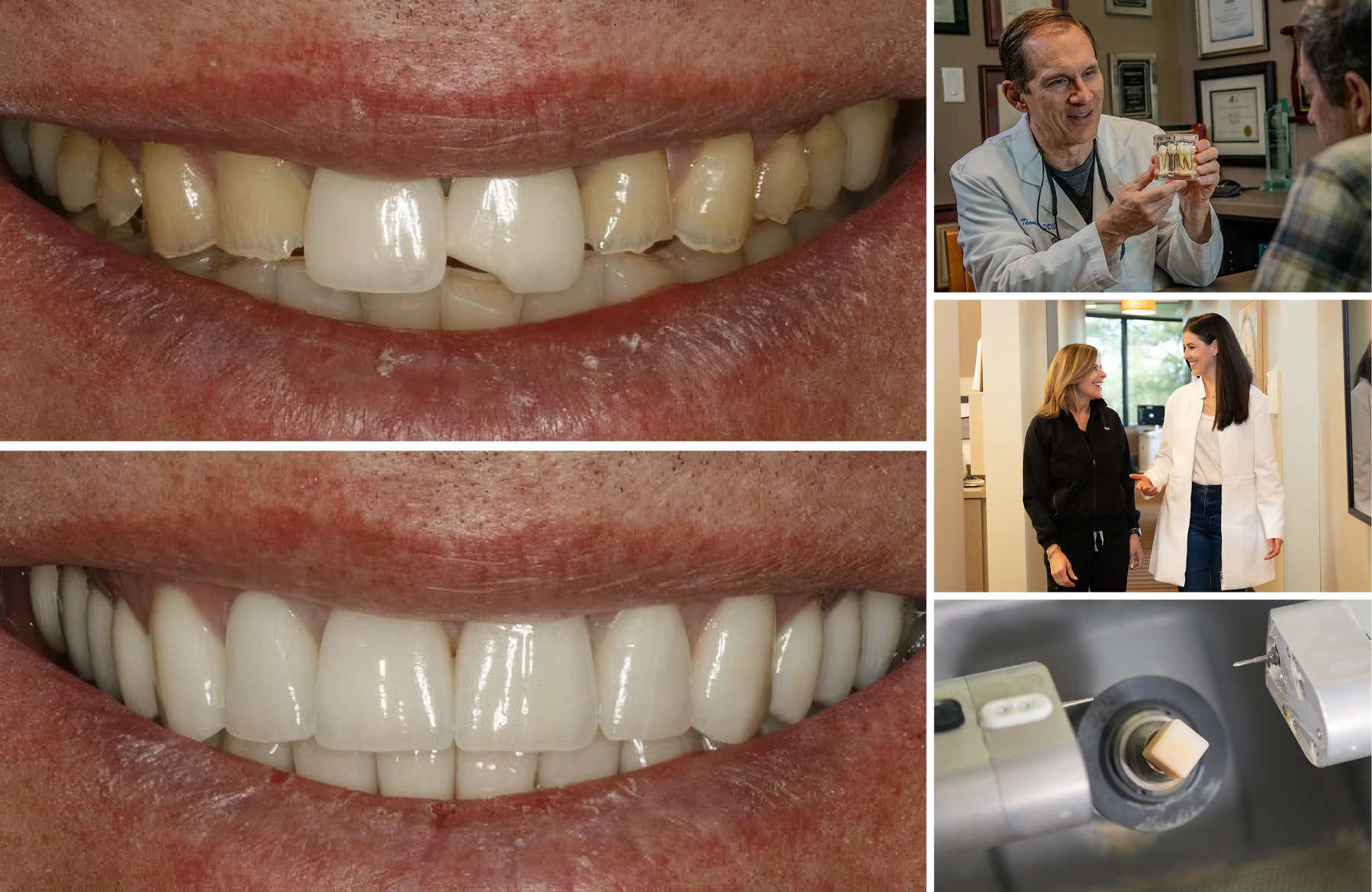 collage of before and after dental crowns patient, Dr. Thomas Reed showcasing dental implant crown to patient, Dr. Natalie Lesinski with hygienist, tooth in CEREC machine