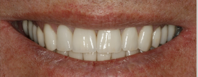 After dental crowns