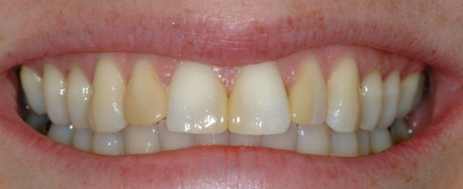 Link Dental patient before veneers
