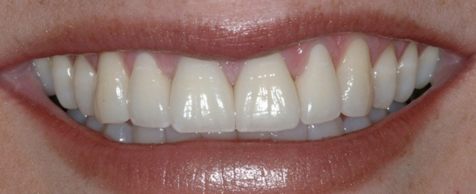 Link Dental patient after veneers