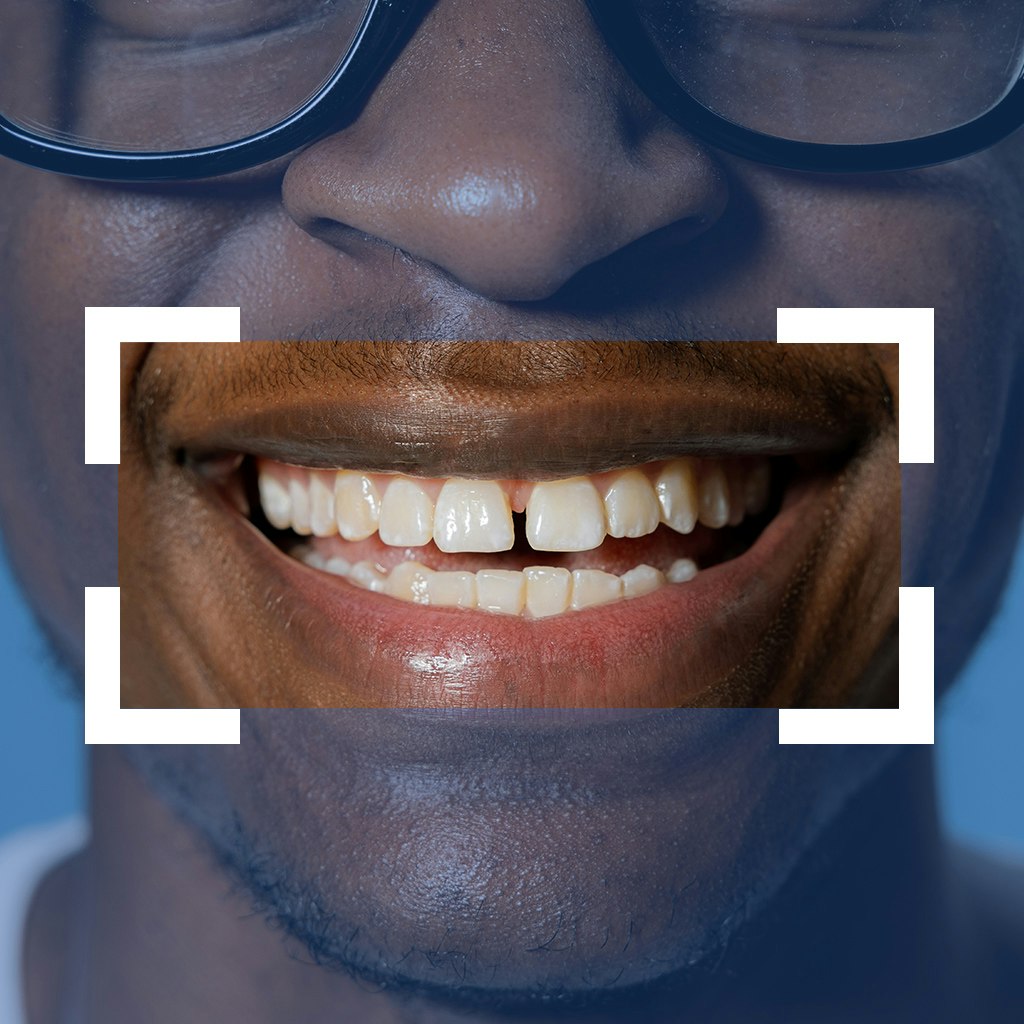 smile makeover