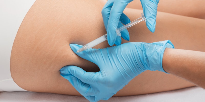 Injection near cellulite and stretch marks