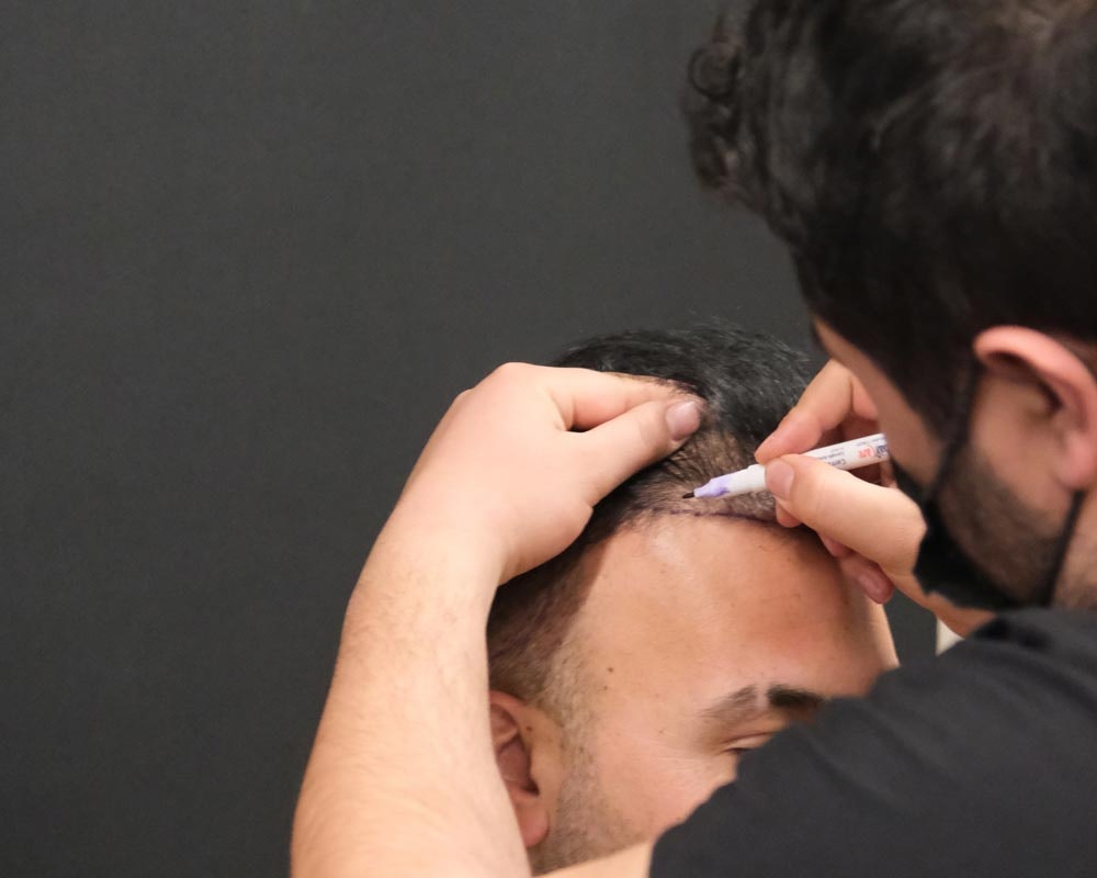 New hairline being marked before FUE procedure