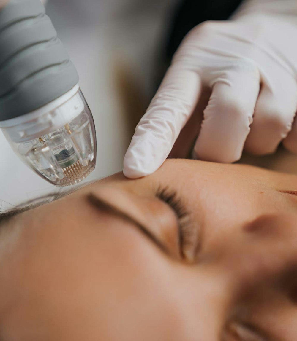 Close-up of gloved hands performing microneedling treatment on a woman’s forehead using a handheld device