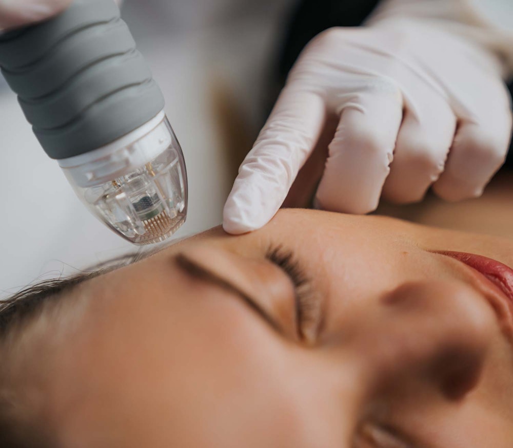 Close-up of gloved hands performing microneedling treatment on a woman’s forehead using a handheld device