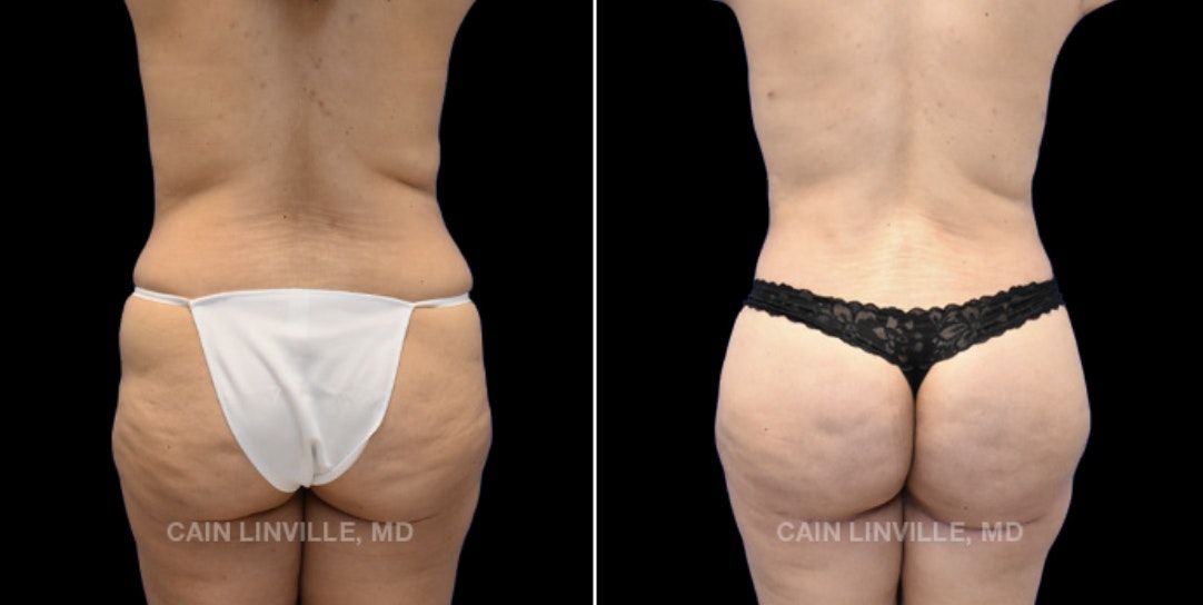 before and after bbl