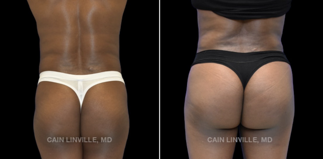 before and after bbl