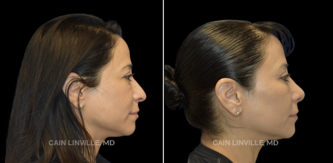 rhinoplasty before and after