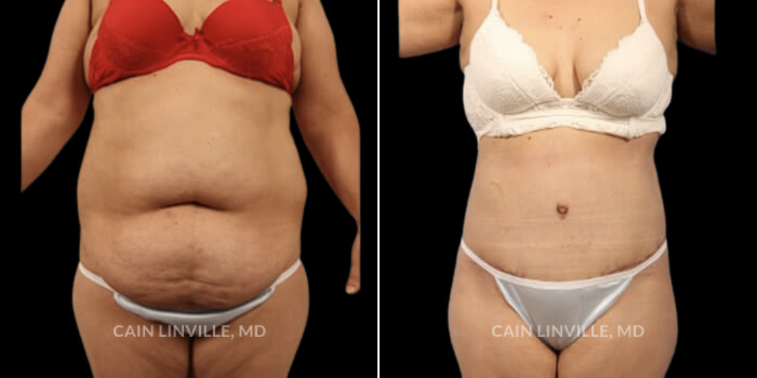 before and after liposuction