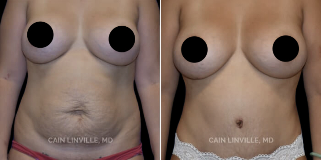 b&a liposuction